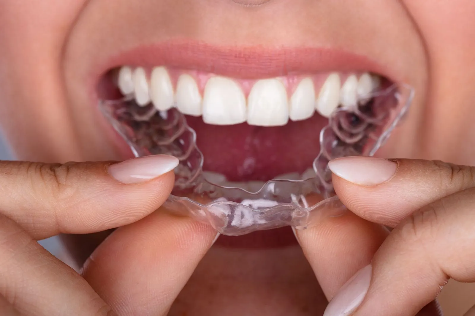 Doorzichtige Invisalign-aligner wordt geplaatst